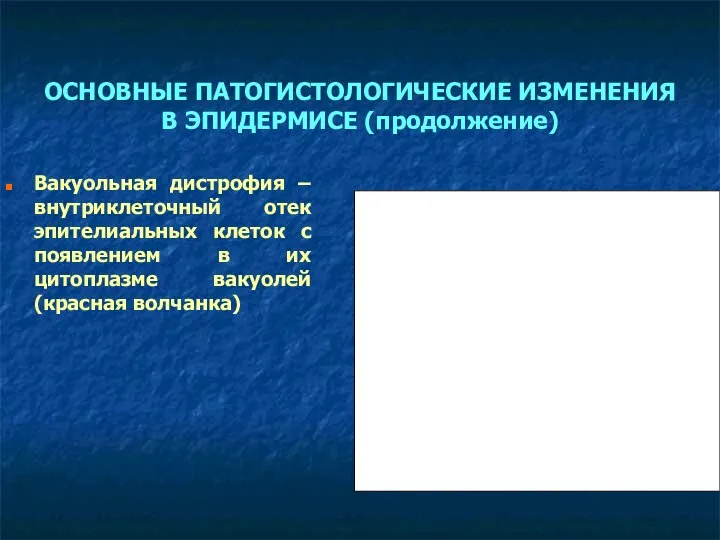 ОСНОВНЫЕ ПАТОГИСТОЛОГИЧЕСКИЕ ИЗМЕНЕНИЯ В ЭПИДЕРМИСЕ (продолжение) Вакуольная дистрофия – внутриклеточный отек