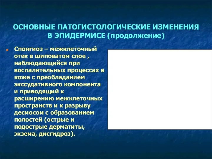 ОСНОВНЫЕ ПАТОГИСТОЛОГИЧЕСКИЕ ИЗМЕНЕНИЯ В ЭПИДЕРМИСЕ (продолжение) Спонгиоз – межклеточный отек в