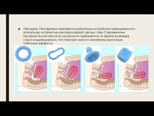 Пессарии. Пессариями называются различные устройства помещаемые во влагалище, которые как распорка