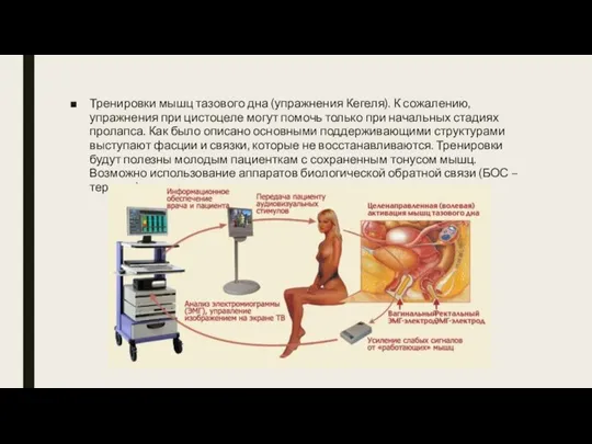 Тренировки мышц тазового дна (упражнения Кегеля). К сожалению, упражнения при цистоцеле