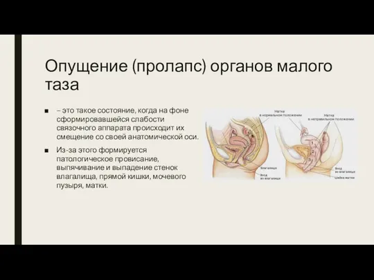 Опущение (пролапс) органов малого таза – это такое состояние, когда на