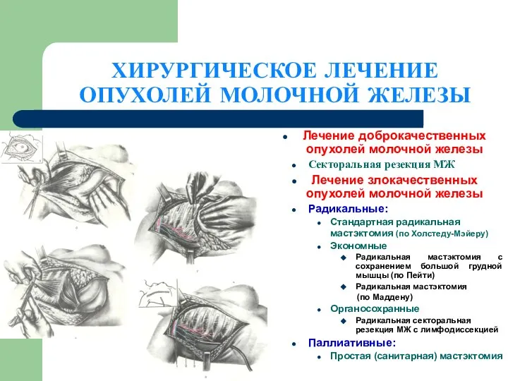 ХИРУРГИЧЕСКОЕ ЛЕЧЕНИЕ ОПУХОЛЕЙ МОЛОЧНОЙ ЖЕЛЕЗЫ Лечение доброкачественных опухолей молочной железы Секторальная