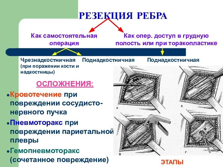 РЕЗЕКЦИЯ РЕБРА ОСЛОЖНЕНИЯ: Кровотечение при повреждении сосудисто-нервного пучка Пневмоторакс при повреждении