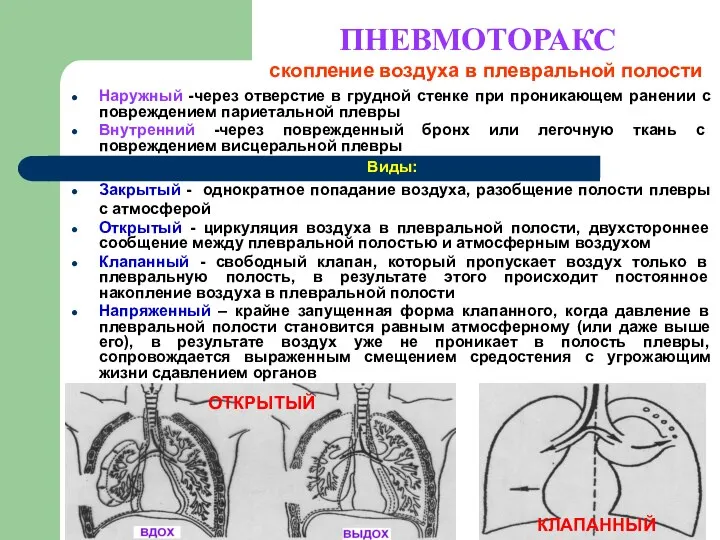 ПНЕВМОТОРАКС Наружный -через отверстие в грудной стенке при проникающем ранении с