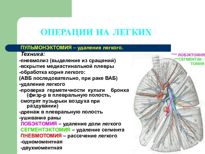 ОПЕРАЦИИ НА ЛЕГКИХ ПУЛЬМОНЭКТОМИЯ – удаление легкого. Техника: -пневмолиз (выделение из