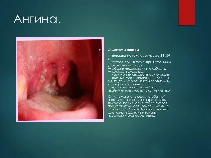 Ангина. Симптомы ангины — повышение температуры до 38-39°С — острая боль