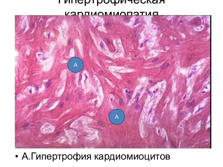Гипертрофическая кардиомиопатия А.Гипертрофия кардиомиоцитов А А