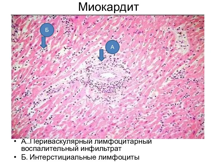 Миокардит А..Периваскулярный лимфоцитарный воспалительный инфильтрат Б. Интерстициальные лимфоциты А Б