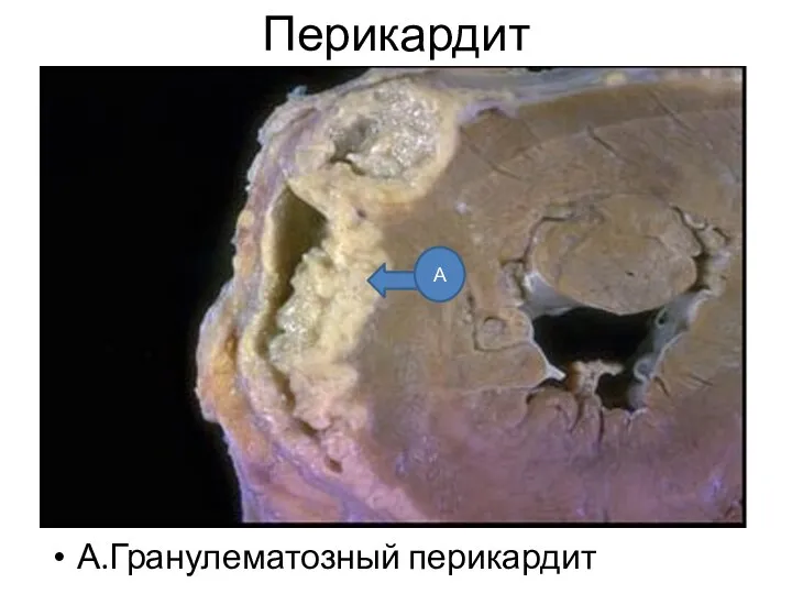 Перикардит А.Гранулематозный перикардит А