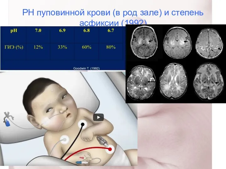 РН пуповинной крови (в род зале) и степень асфиксии (1992)