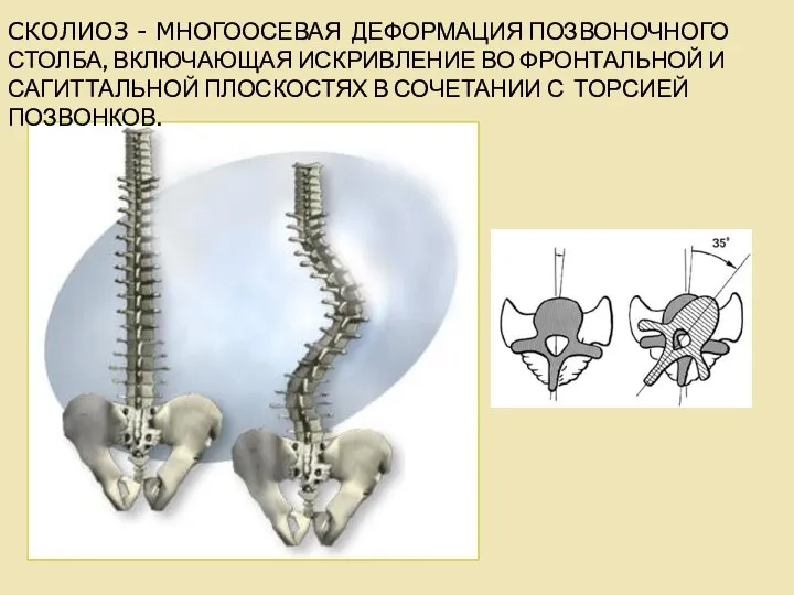 СКОЛИОЗ - МНОГООСЕВАЯ ДЕФОРМАЦИЯ ПОЗВОНОЧНОГО СТОЛБА, ВКЛЮЧАЮЩАЯ ИСКРИВЛЕНИЕ ВО ФРОНТАЛЬНОЙ И