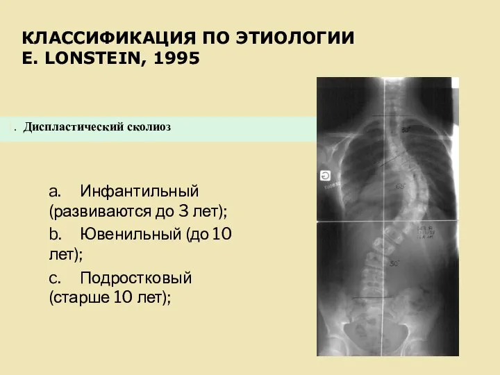 КЛАССИФИКАЦИЯ ПО ЭТИОЛОГИИ E. LONSTEIN, 1995 a. Инфантильный (развиваются до 3