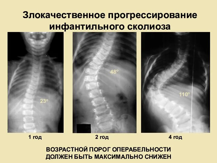 Злокачественное прогрессирование инфантильного сколиоза ВОЗРАСТНОЙ ПОРОГ ОПЕРАБЕЛЬНОСТИ ДОЛЖЕН БЫТЬ МАКСИМАЛЬНО СНИЖЕН