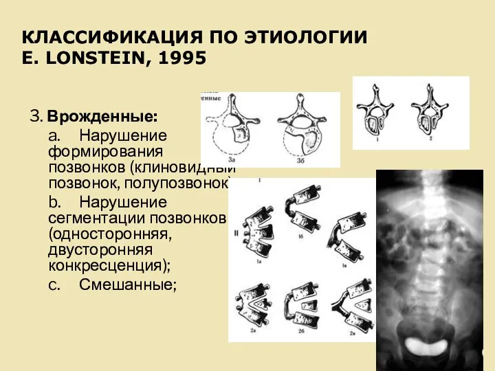 КЛАССИФИКАЦИЯ ПО ЭТИОЛОГИИ E. LONSTEIN, 1995 3. Врожденные: a. Нарушение формирования