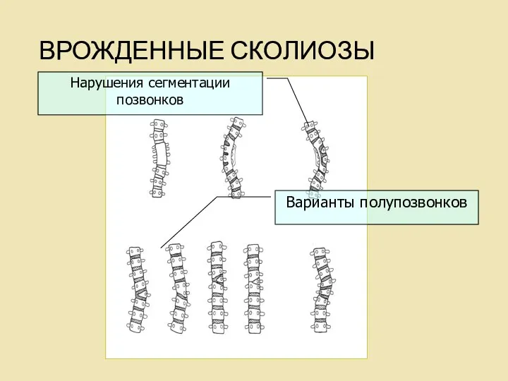 Нарушения сегментации позвонков Варианты полупозвонков ВРОЖДЕННЫЕ СКОЛИОЗЫ