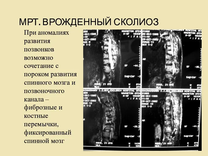 МРТ. ВРОЖДЕННЫЙ СКОЛИОЗ При аномалиях развития позвонков возможно сочетание с пороком