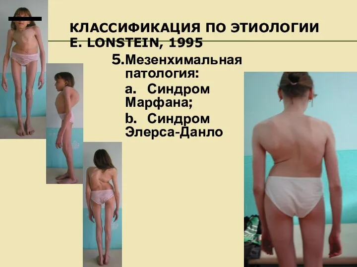 КЛАССИФИКАЦИЯ ПО ЭТИОЛОГИИ E. LONSTEIN, 1995 5. Мезенхимальная патология: a. Синдром Марфана; b. Синдром Элерса-Данло