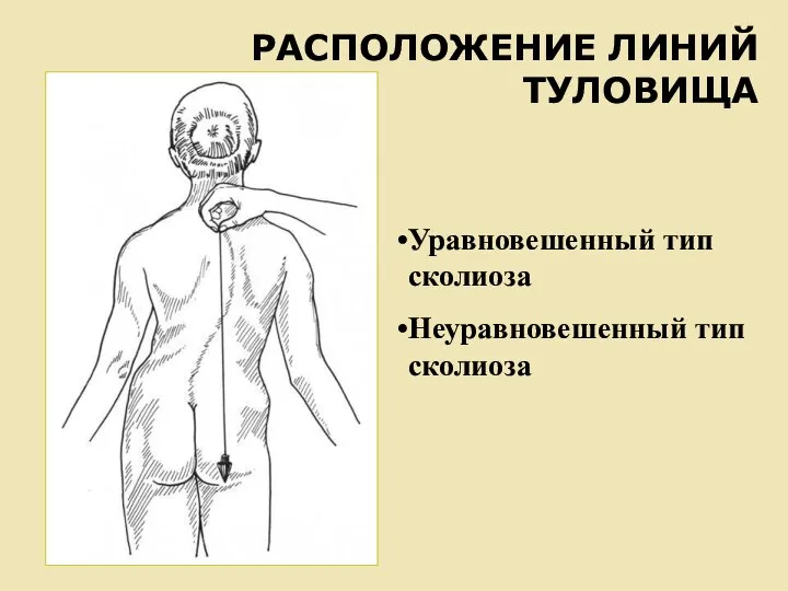 РАСПОЛОЖЕНИЕ ЛИНИЙ ТУЛОВИЩА Уравновешенный тип сколиоза Неуравновешенный тип сколиоза