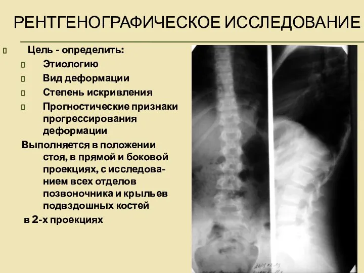 РЕНТГЕНОГРАФИЧЕСКОЕ ИССЛЕДОВАНИЕ Цель - определить: Этиологию Вид деформации Степень искривления Прогностические