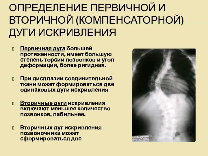 ОПРЕДЕЛЕНИЕ ПЕРВИЧНОЙ И ВТОРИЧНОЙ (КОМПЕНСАТОРНОЙ) ДУГИ ИСКРИВЛЕНИЯ Первичная дуга большей протяженности,