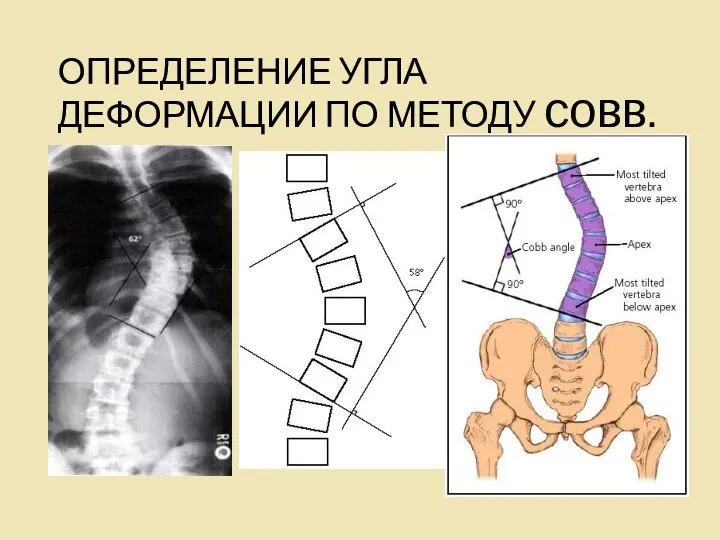 ОПРЕДЕЛЕНИЕ УГЛА ДЕФОРМАЦИИ ПО МЕТОДУ COBB.