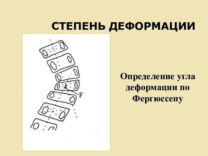 СТЕПЕНЬ ДЕФОРМАЦИИ Определение угла деформации по Фергюссену