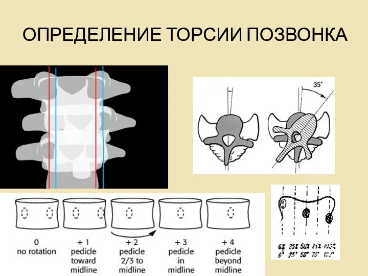 ОПРЕДЕЛЕНИЕ ТОРСИИ ПОЗВОНКА