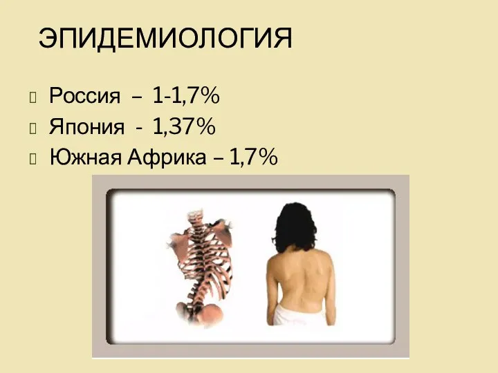 ЭПИДЕМИОЛОГИЯ Россия – 1-1,7% Япония - 1,37% Южная Африка – 1,7%