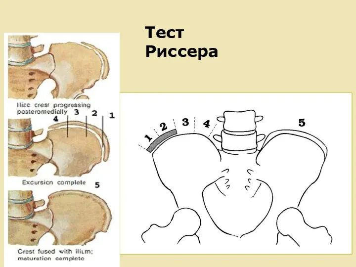 Тест Риссера