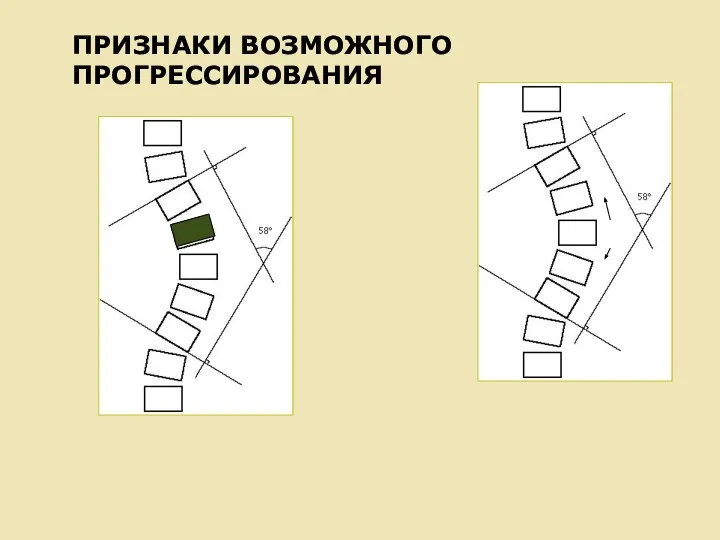 ПРИЗНАКИ ВОЗМОЖНОГО ПРОГРЕССИРОВАНИЯ Симптом Мовшовича – остеопороз вершинного позвонка Симптом Кона – клиновидность межпозвонкового пространства