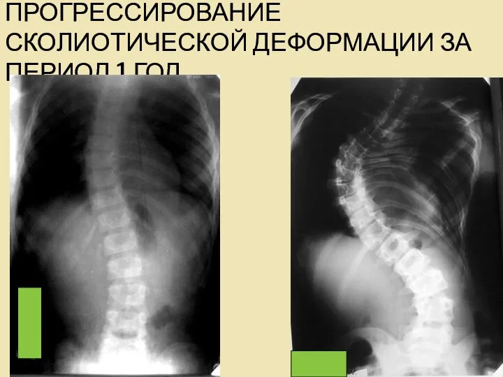 ПРОГРЕССИРОВАНИЕ СКОЛИОТИЧЕСКОЙ ДЕФОРМАЦИИ ЗА ПЕРИОД 1 ГОД