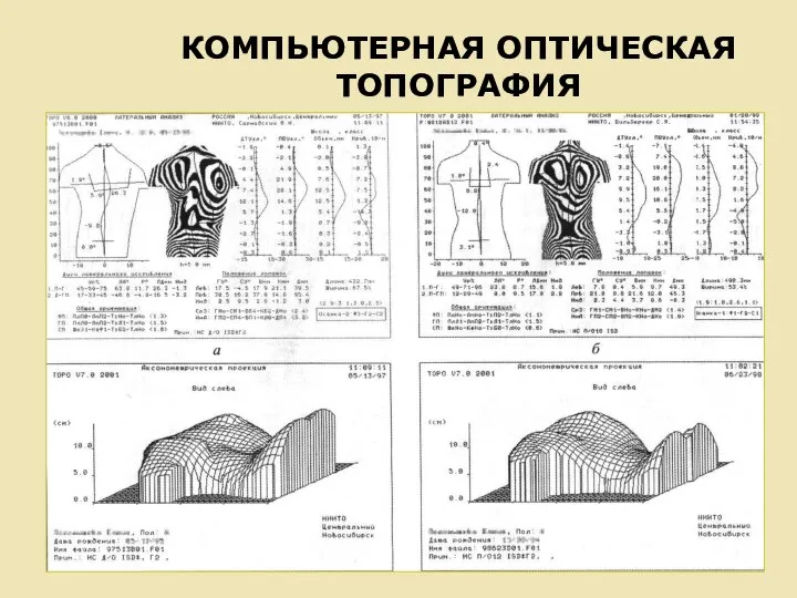 КОМПЬЮТЕРНАЯ ОПТИЧЕСКАЯ ТОПОГРАФИЯ