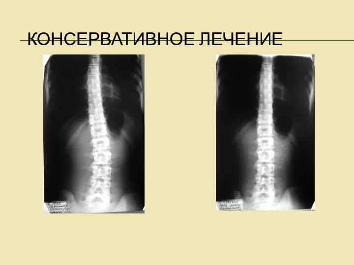 КОНСЕРВАТИВНОЕ ЛЕЧЕНИЕ Коррекция позвоночника корригирующей стелькой при гипоплазии конечности