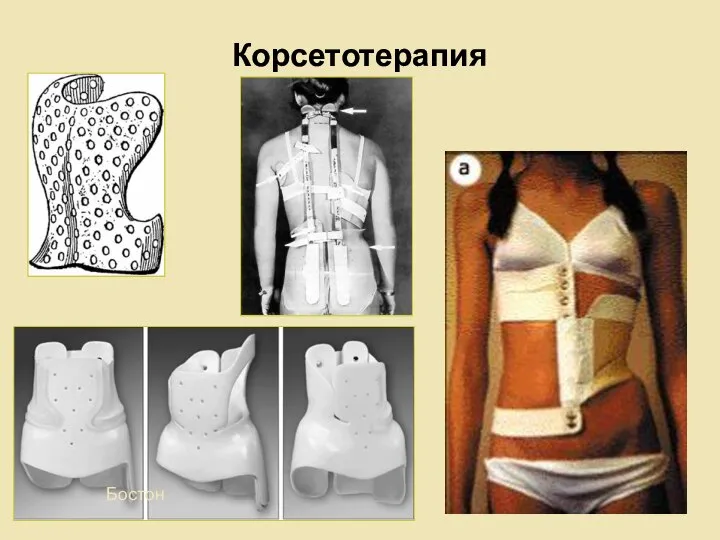 Корсетотерапия Амбруаз Паре Бостон