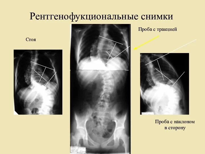 Рентгенофукциональные снимки Стоя Проба с тракцией Проба с наклоном в сторону 76* 65* 45*