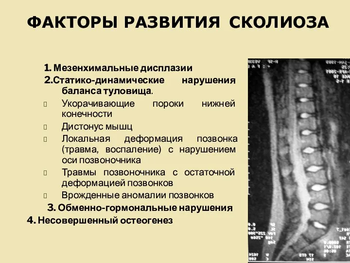 ФАКТОРЫ РАЗВИТИЯ СКОЛИОЗА 1. Мезенхимальные дисплазии 2.Статико-динамические нарушения баланса туловища. Укорачивающие