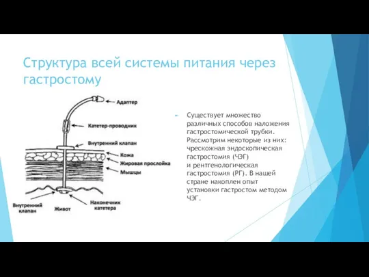 Структура всей системы питания через гастростому Существует множество различных способов наложения