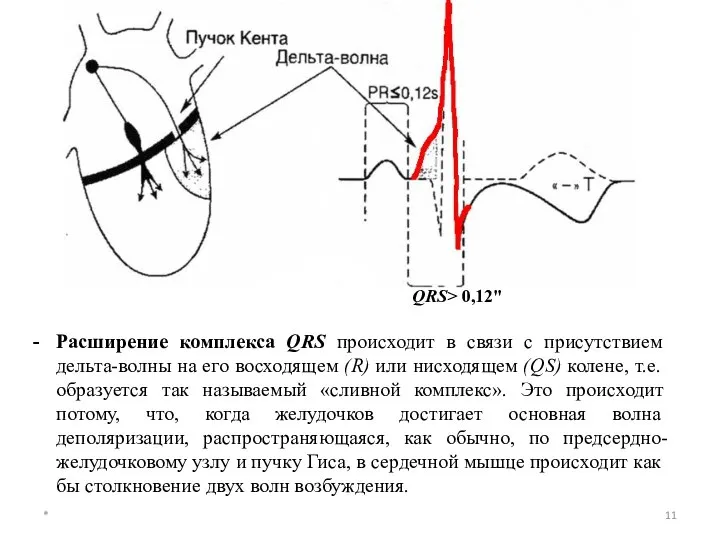 * Расширение комплекса QRS происходит в связи с присутствием дельта-волны на