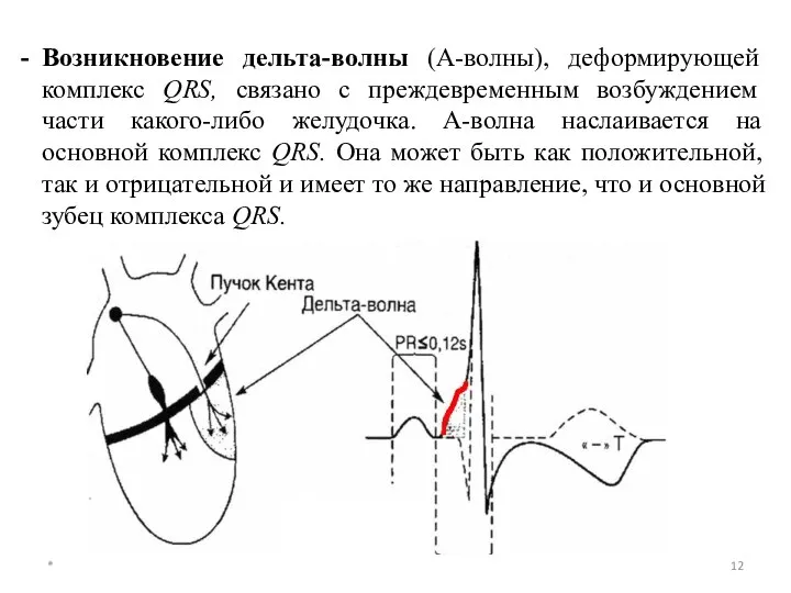 * Возникновение дельта-волны (А-волны), деформирующей комплекс QRS, связано с преждевременным возбуждением