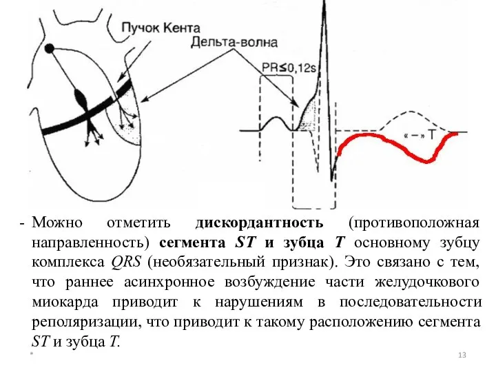 * Можно отметить дискордантность (противоположная направленность) сегмента ST и зубца Т