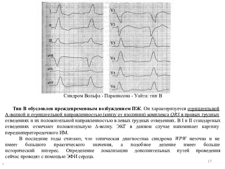 * Синдром Вольфа - Паркинсона - Уайта: тип В Тип В