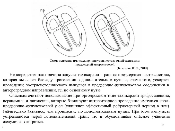 * Схема движения импульса при индукции ортодромной тахикардии предсердной экстрасистолой (Терегулов