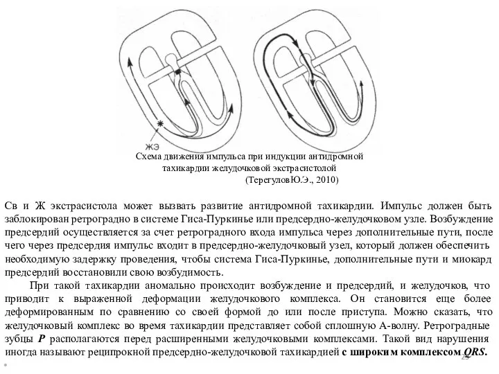 * Схема движения импульса при индукции антидромной тахикардии желудочковой экстрасистолой (ТерегуловЮ.Э.,