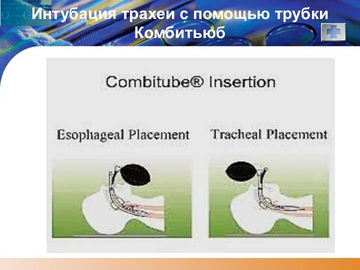 Интубация трахеи с помощью трубки Комбитьюб