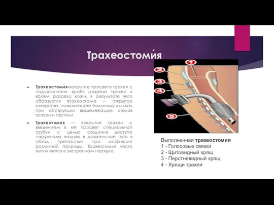 Трахеостоми́я Трахеостоми́я-вскрытие просвета трахеи с подшиванием краёв разреза трахеи к краям