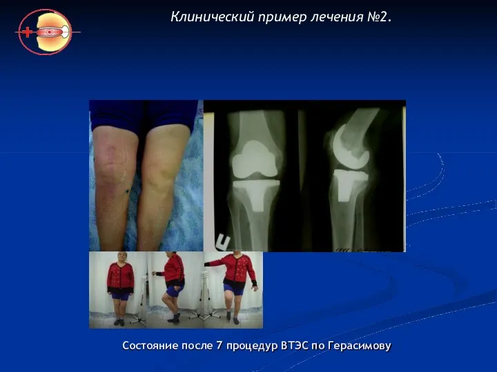 Состояние после 7 процедур ВТЭС по Герасимову Клинический пример лечения №2.