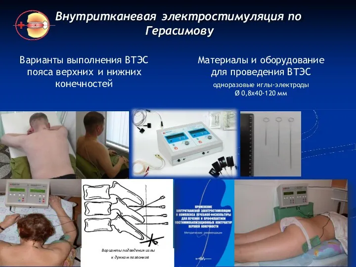 Внутритканевая электростимуляция по Герасимову Варианты выполнения ВТЭС пояса верхних и нижних