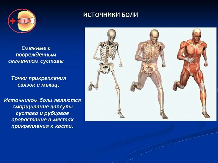 ИСТОЧНИКИ БОЛИ Смежные с поврежденным сегментом суставы Точки прикрепления связок и