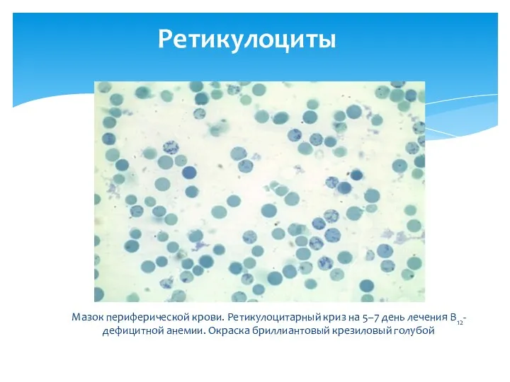 Мазок периферической крови. Ретикулоцитарный криз на 5–7 день лечения В12-дефицитной анемии. Окраска бриллиантовый крезиловый голубой Ретикулоциты