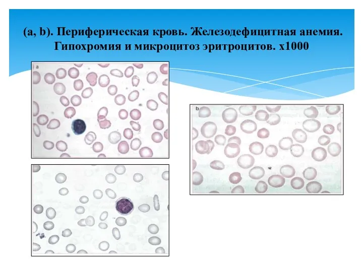 (a, b). Периферическая кровь. Железодефицитная анемия. Гипохромия и микроцитоз эритроцитов. х1000